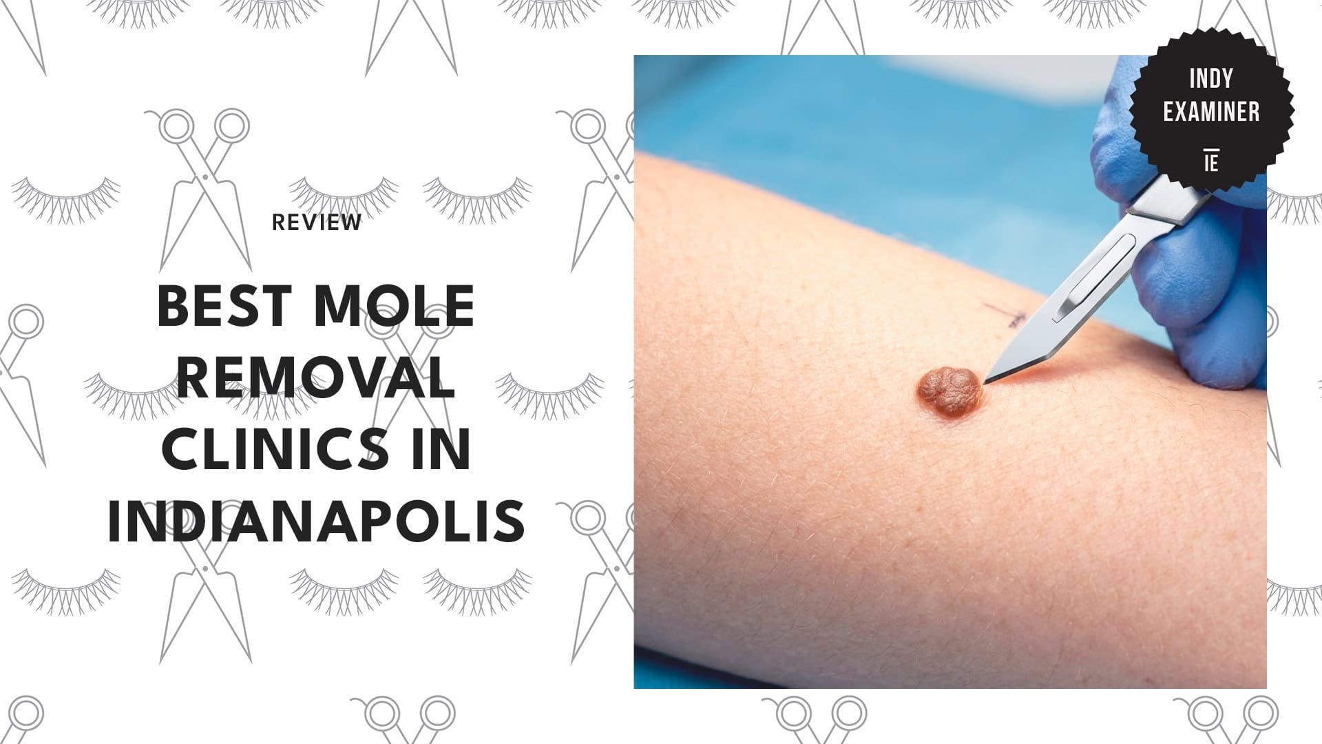 best-mole-removal-indianapolis-banner
