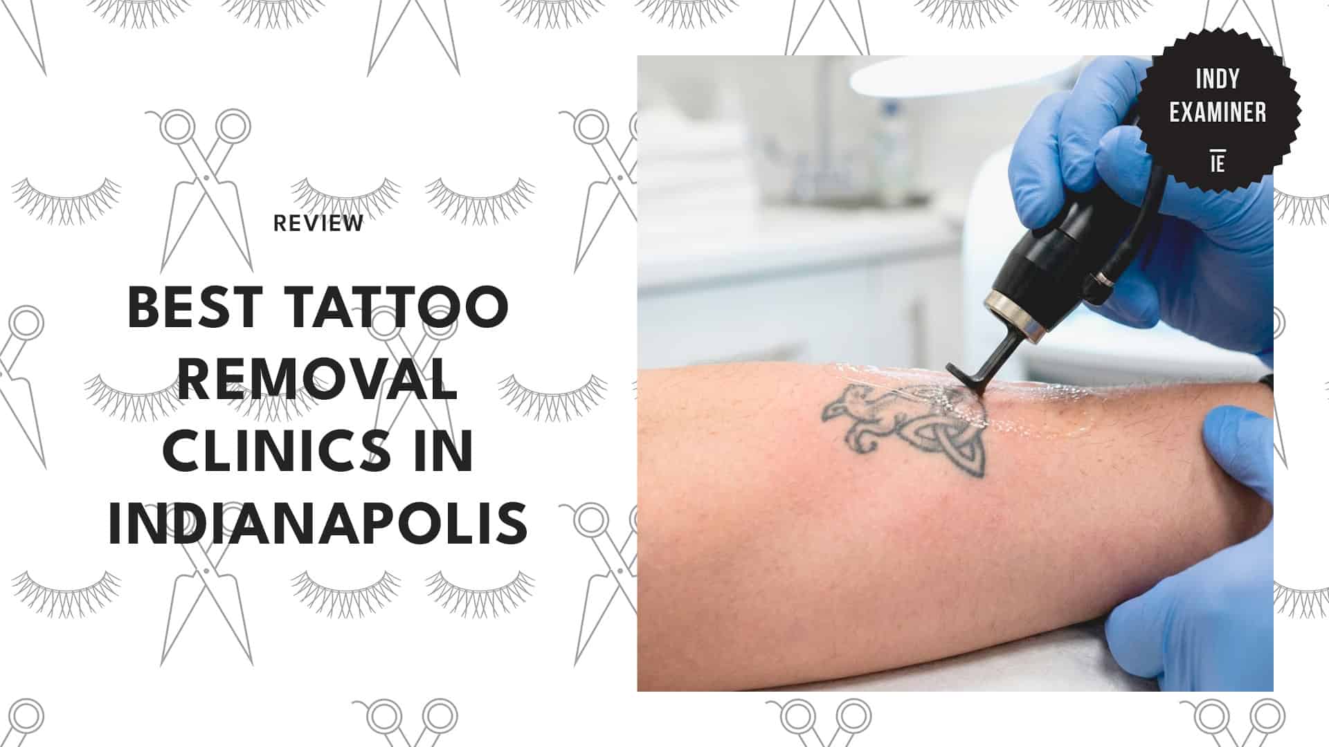 tattoo-removal-in-indianapolis